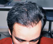 calvitie greffe cheveux implant capillaire